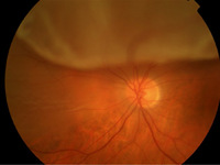 Photo-of-a-Retinal-Detachment